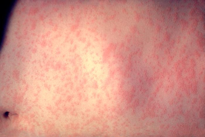 Measles outbreak reaches East Bay